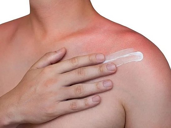 Síntomas de la alergia al sol