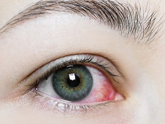 Síntomas de la Alergia en los Ojos