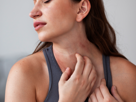 ¿Qué es la Urticaria Crónica Espontánea?