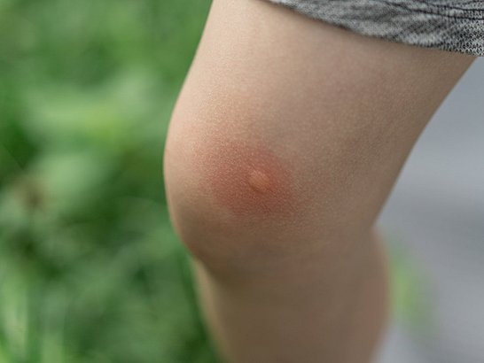 Síntomas de alergia al veneno de insectos