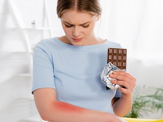 Síntomas de la alergia al chocolate